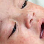 Measles-outbreak-declared-in-Philippines